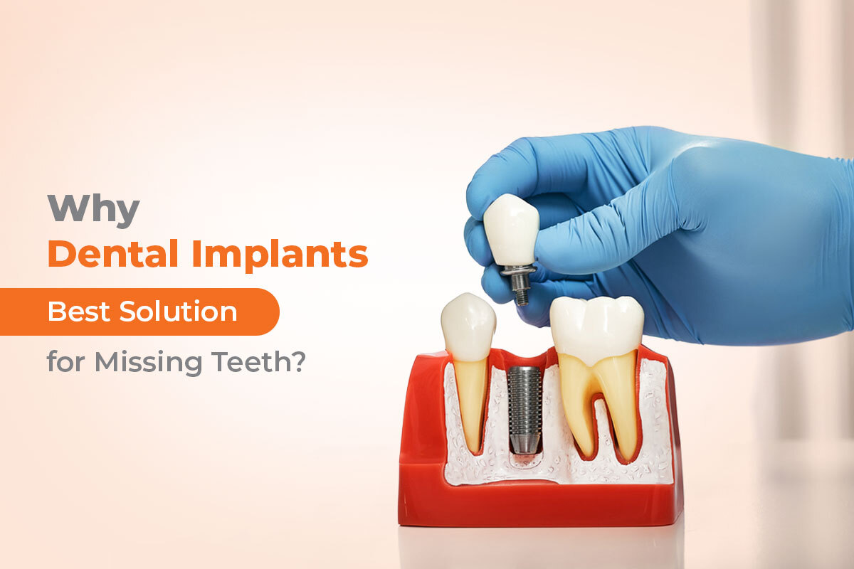 Why Dental Implants Are the Best Solution for Missing Teeth?