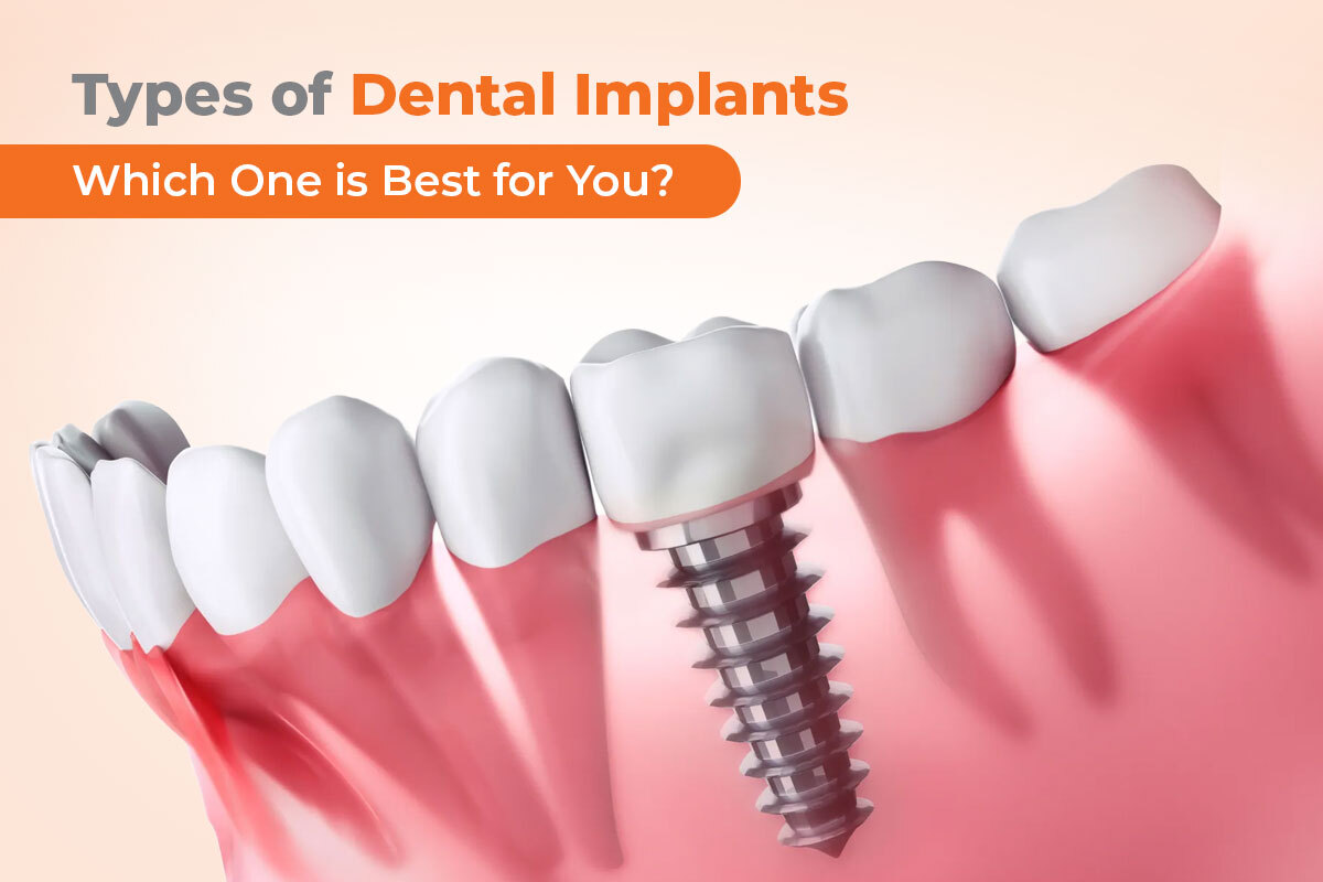 Types of Dental Implants and Which One is Best for You?