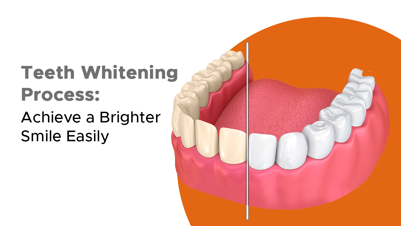 Teeth Whitening Process: Achieve a Brighter Smile Easily
