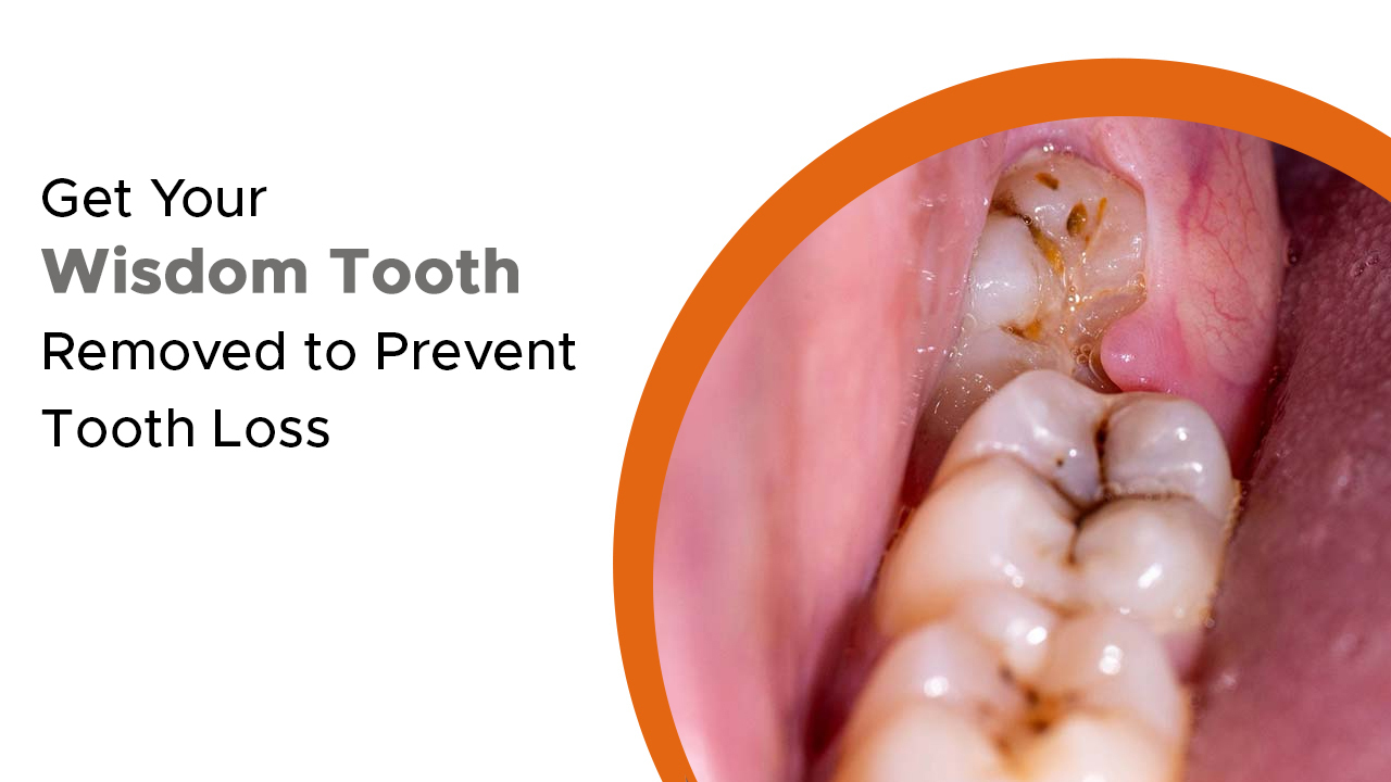Get Your Wisdom Tooth Removed to Prevent Tooth Loss