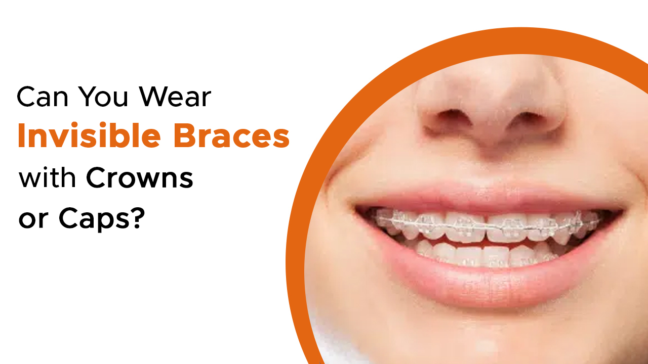 can-you-wear-invisible-braces-with-crowns-or-caps