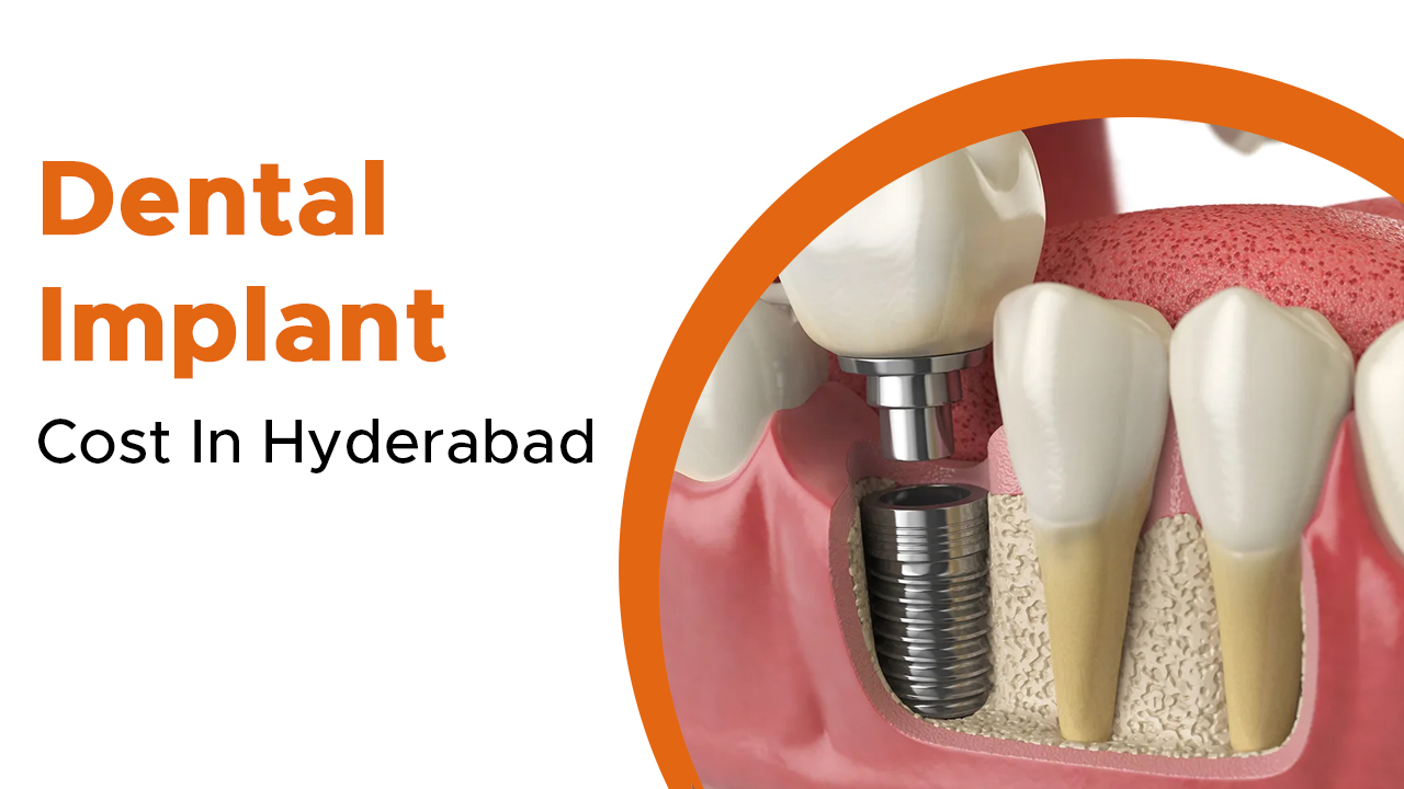 Dental Implant Cost In Hyderabad