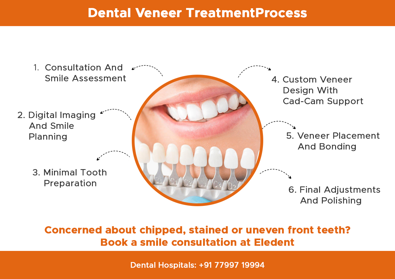 dental-veneer-treatment process