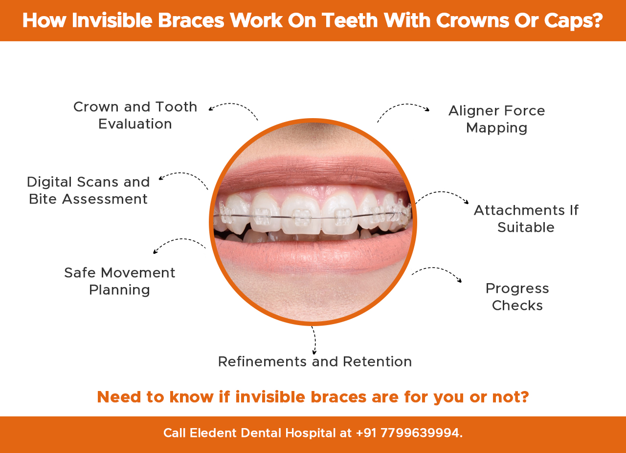 how-invisible-braces-work-on-teeth-with-crowns-or-caps