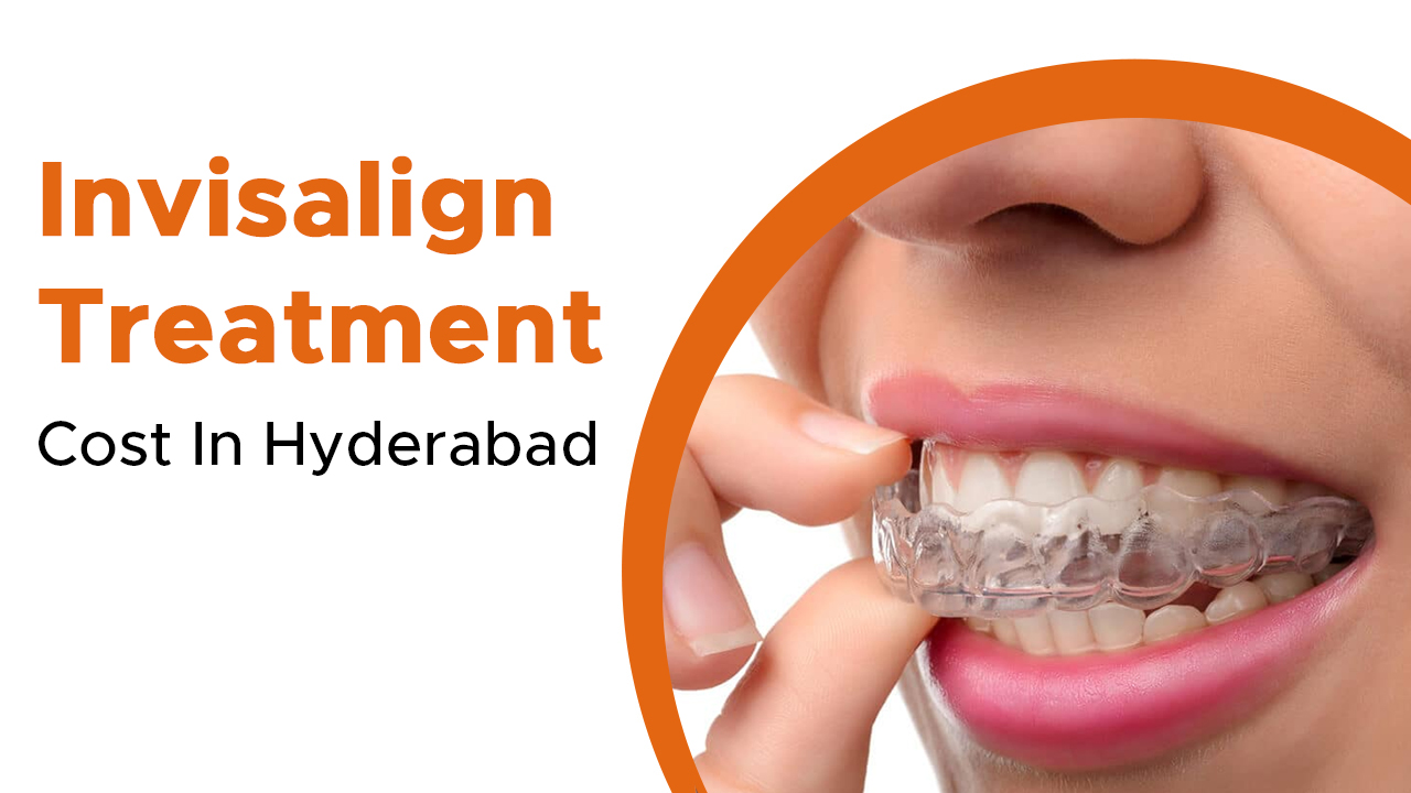 Invisalign Treatment Cost In Hyderabad