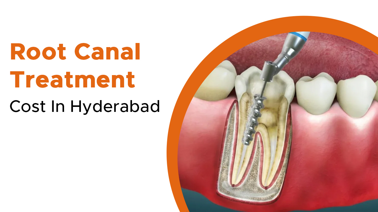 Root Canal Treatment Cost In Hyderabad